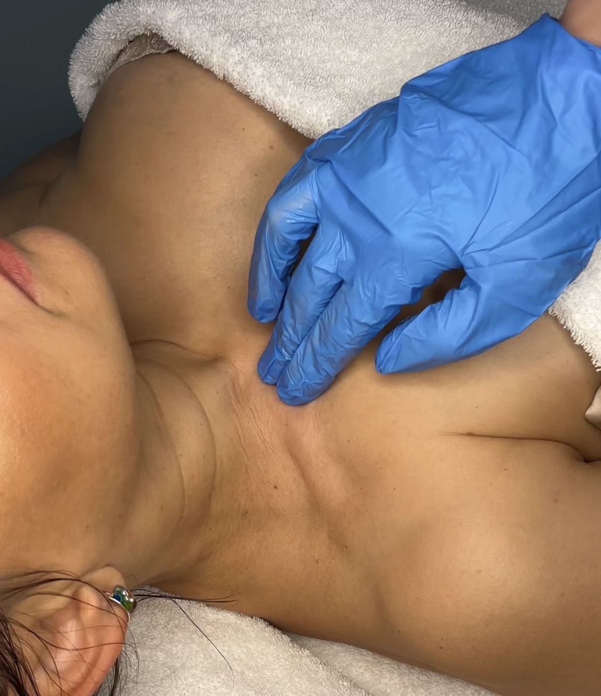 Lymfocontouring tela